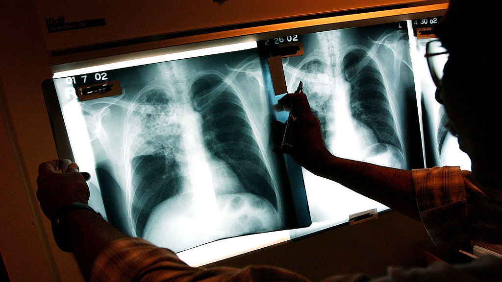 2 active tuberculosis cases traced to San Francisco strip club — KTVU FOX 2 Bay Area, Ross Health news